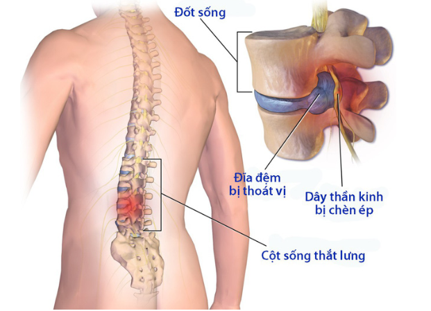 hình ảnh giải phẫu thoát vị đĩa đệm lưng