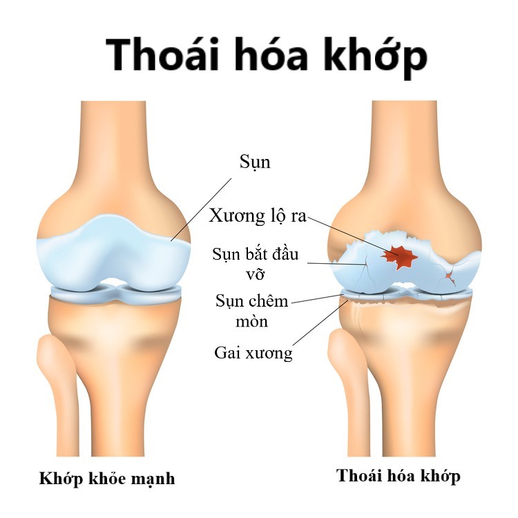 Thoái hoá khớp gối - Nguyên nhân, dấu hiệu nhận biết và cách điều trị hiệu quả