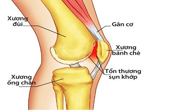 Tổng hợp danh sách các bệnh thường gặp ở khớp gối