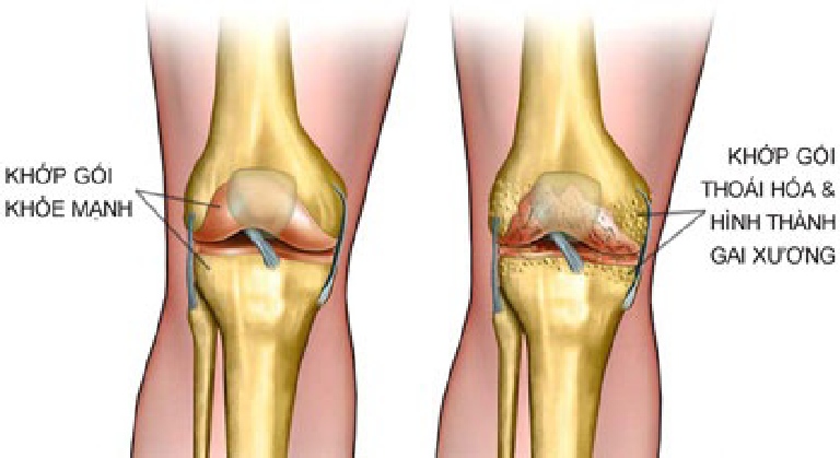 TỔNG QUAN VỀ BỆNH GAI KHỚP GỐI 