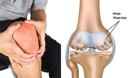 ĐAU ĐẦU GỐI CÓ PHẢI THOÁI HOÁ KHỚP GỐI KHÔNG?
