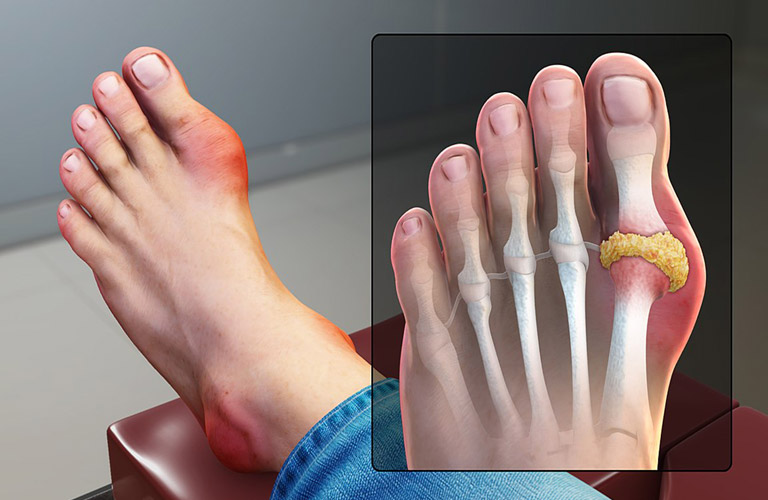 Bệnh Gout ( gút ): Nguyên nhân, triệu chứng và phương pháp hỗ trợ điều trị