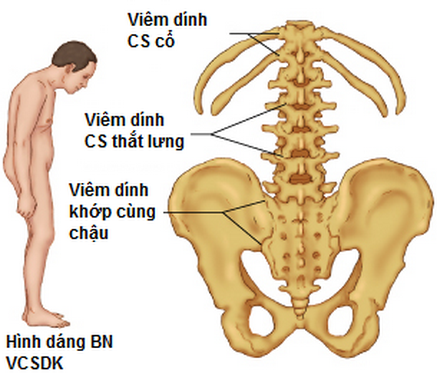 VIÊM CỘT SỐNG DÍNH KHỚP - TOÀN BỘ BỆNH HỌC