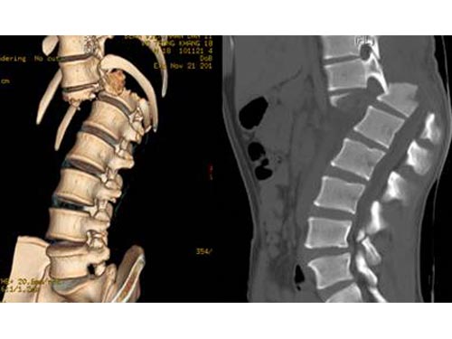 Thoái hóa đốt sống cổ không chỉ đơn giản là đau mỏi vai gáy