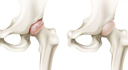 Gia tăng bệnh nhân trẻ hoại tử chỏm xương đùi vì... uống rượu