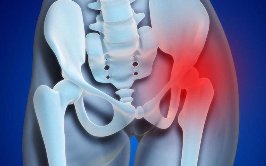 Điều trị hoại tử vô khuẩn chỏm xương đùi bằng liệu pháp đông y