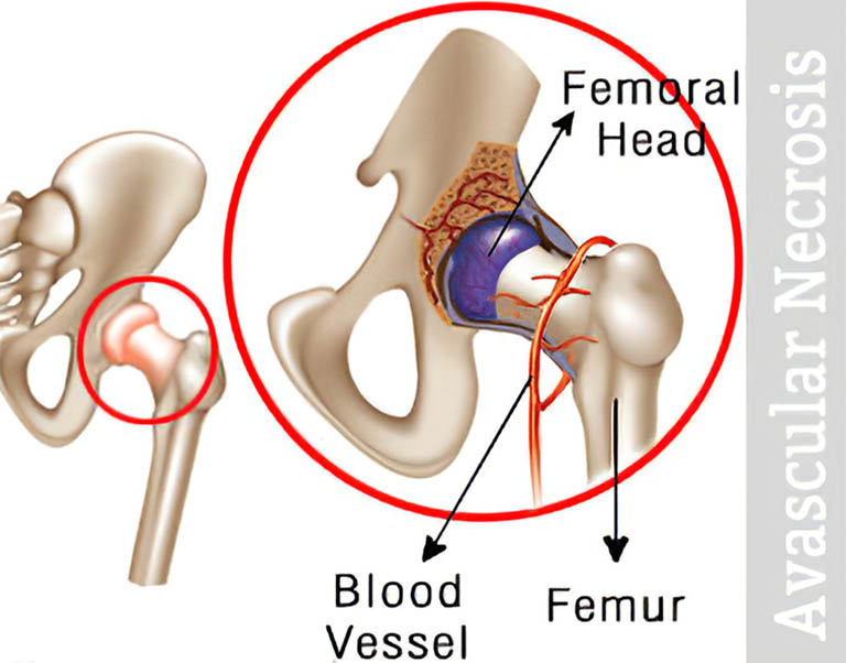 Thoái hóa khớp háng ở người trẻ tuổi