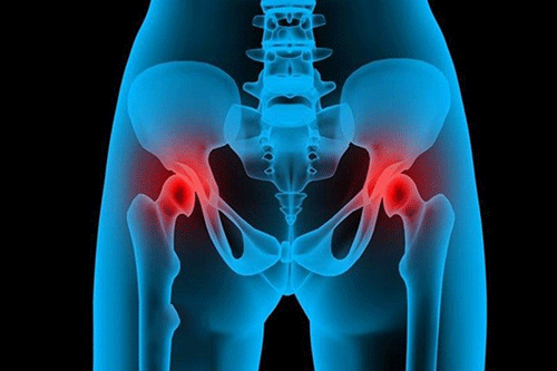 Bước đi đau đớn của bệnh nhân hoại tử chỏm xương đùi