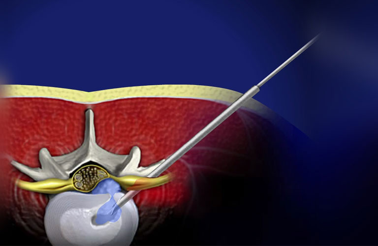 Ứng Dụng Của Ozon trong điều trị thoát vị đĩa đệm, hoại tử chỏm xương đùi