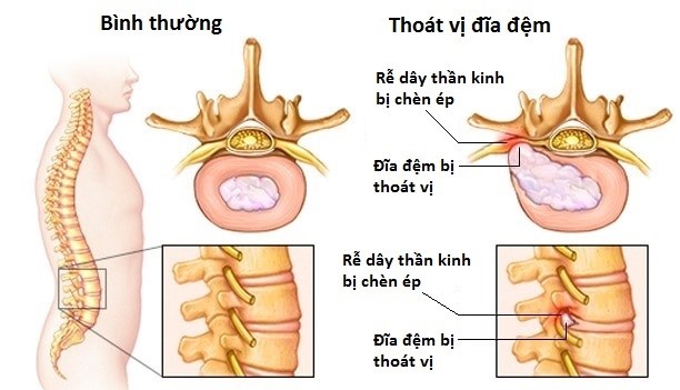 Cách Chữa Thoát Vị Đĩa Đệm Cột Sống Thắt Lưng Hiệu Quả