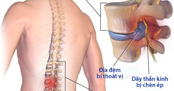 Thoát vị đĩa đệm: Nguyên nhân, triệu chứng, chẩn đoán và điều trị