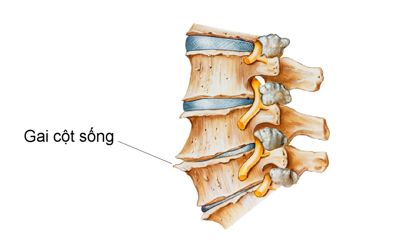 Tiểu Châm Đao - Phương Pháp Hỗ Trợ Điều Trị Gai Cột Sống Khỏi Lâu Dài