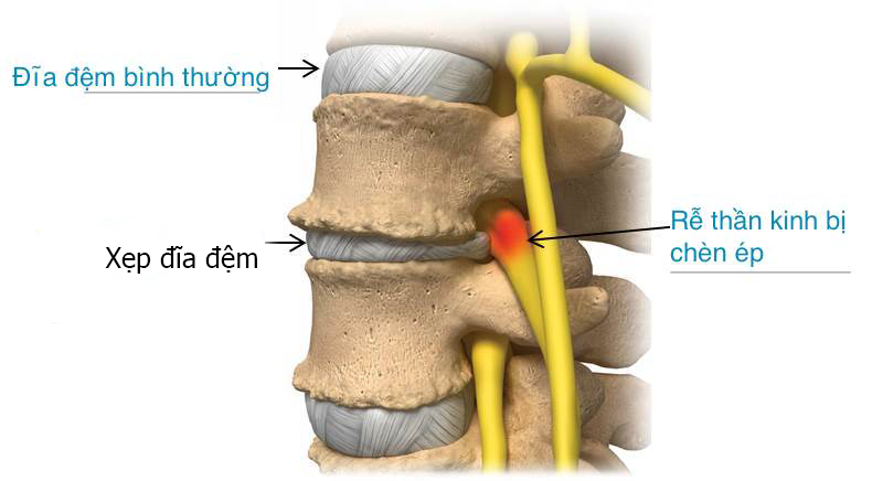 Phương pháp hỗ trợ điều trị thoát vị đĩa đệm mới nhất hiện nay ?