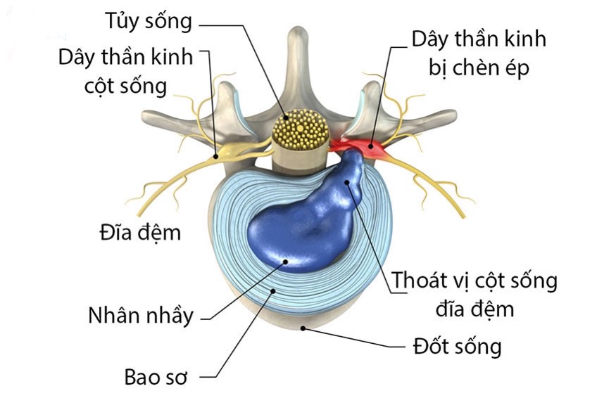 Thoát vị đĩa đệm l4 l5 - l5 s1: Video chi tiết và Phương pháp tin tưởng cho bệnh nhân