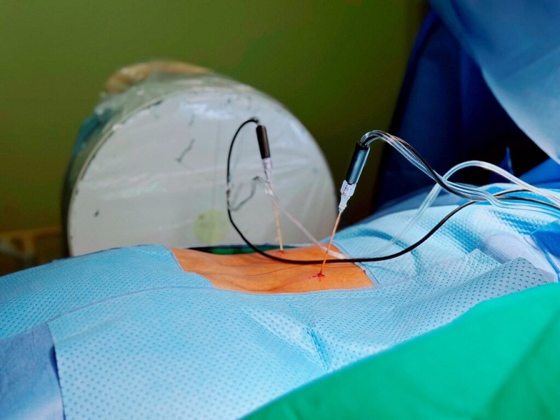 Giải pháp vàng chữa thoát vị đĩa đệm nặng: Sóng RF cao tần kết hợp Ozone – Chuẩn y khoa, không cần phẫu thuật
