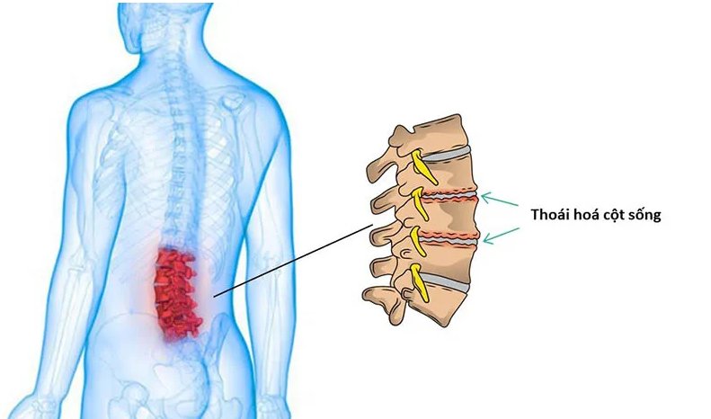 Thoái hóa cột sống có chữa được không? Sự thật bạn cần biết 
